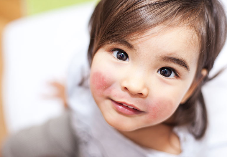Cara mengatasi alergi makanan pada anak